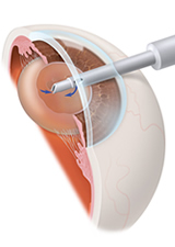 Cataract Surgery | Laser Assisted Surgery | Toric Lens Implants | Lexington KY | Richmond KY