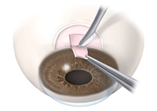 Glaucoma Treatment | Glaucoma Filter Surgery | Lexington KY | Richmond KY